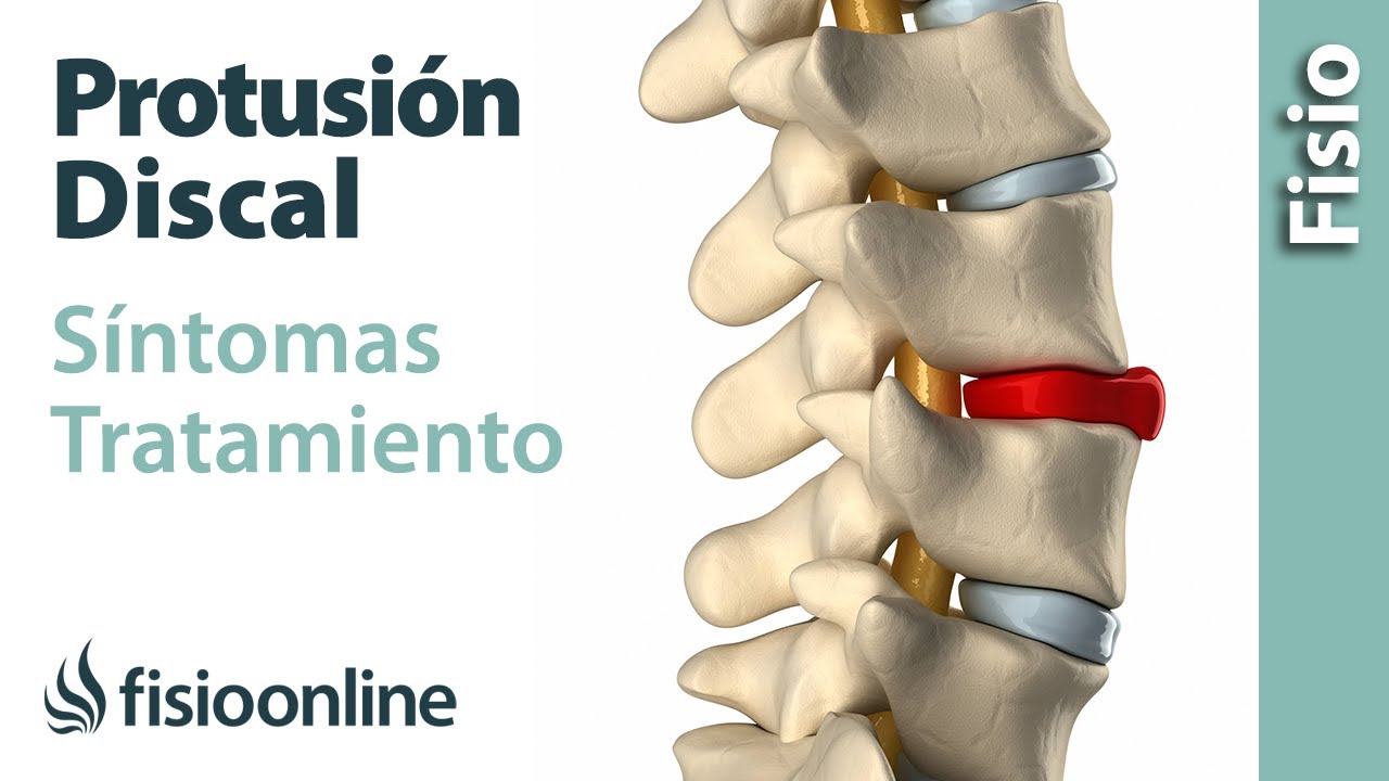 tiempo de baja por protusión discal cervical